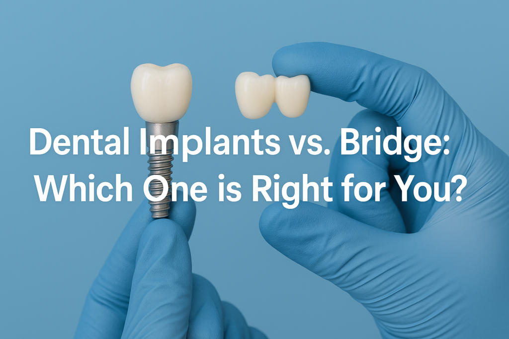 Dental Implants vs. Bridge